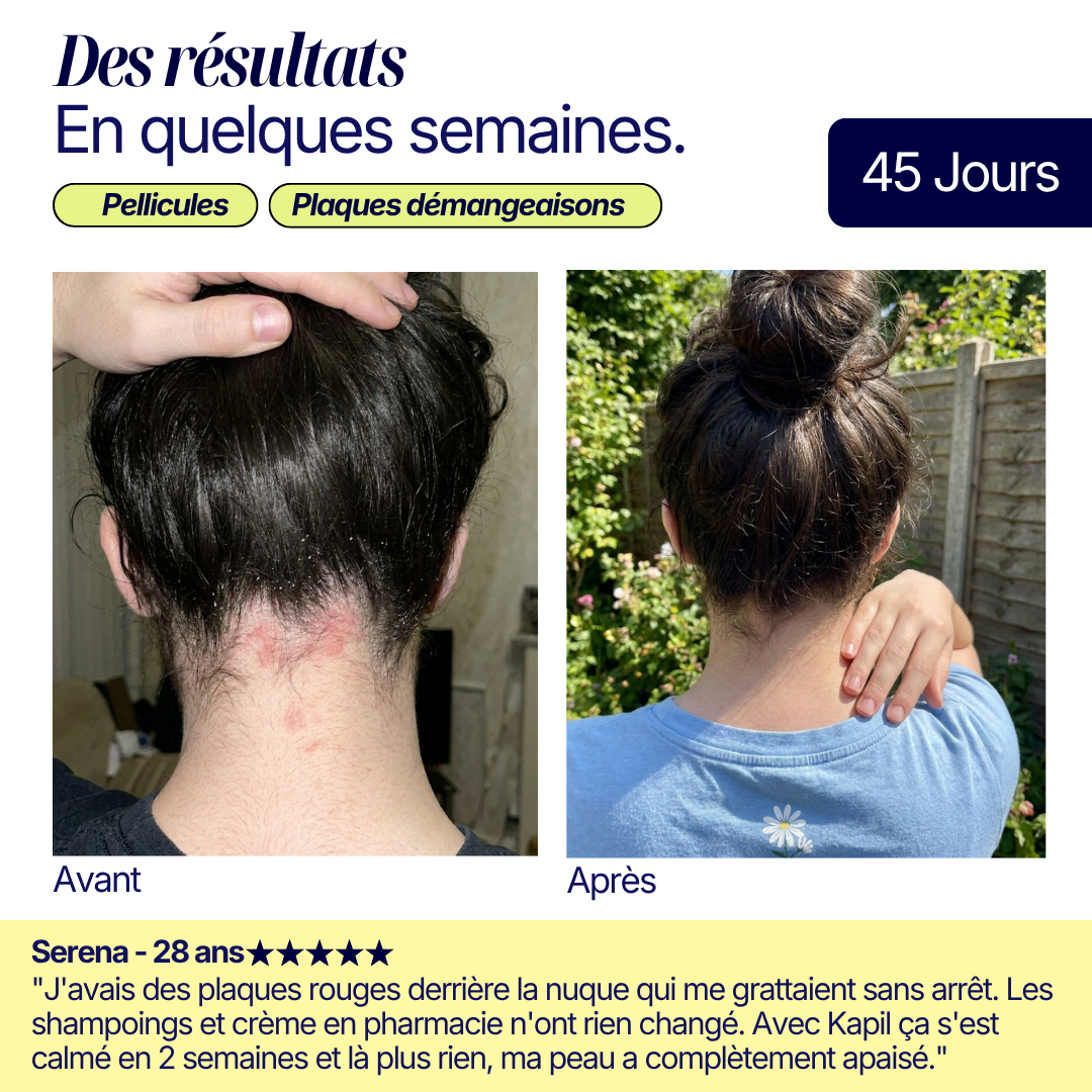Shampoing Solide - Pellicules & Démangeaisons